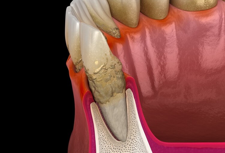 Parodontitis Zahnschema