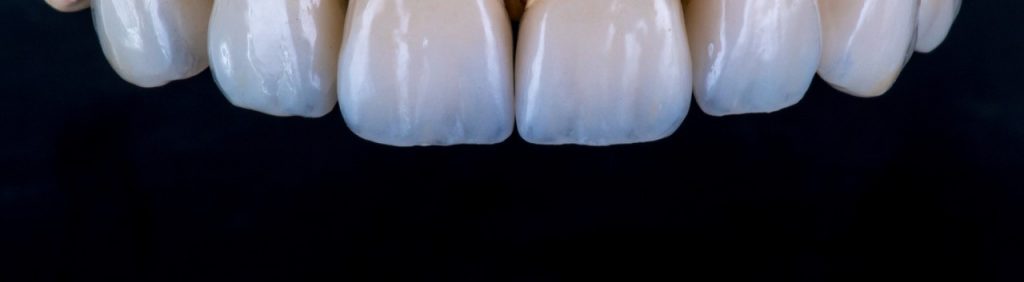 Dentale Veneers und Kronen